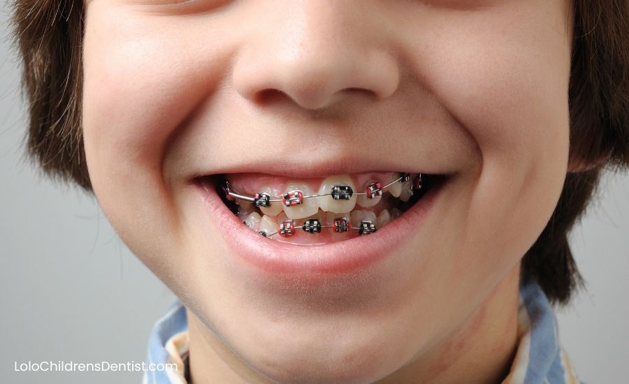 5 Great Tips for Taking Care of Braces in Pediatric Dentistry